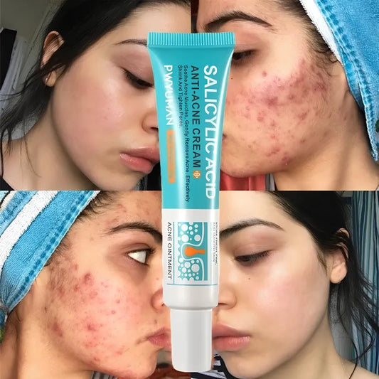 Secativo de Espinhas em Gel - Fórmula Asiática com Ácido Salicílico